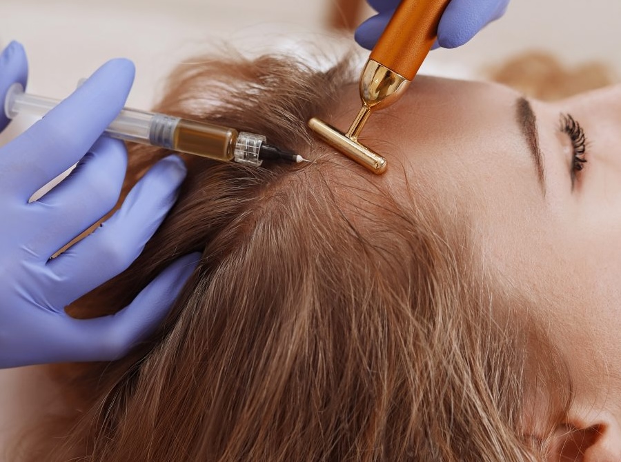 Mesoterapia capilar caida del pelo